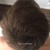Set for hair loss