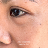 Botox vert + booster de collagène