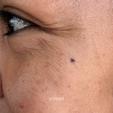 Botox vert + booster de collagène