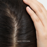 Set for hair loss