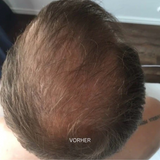 Set for hair loss